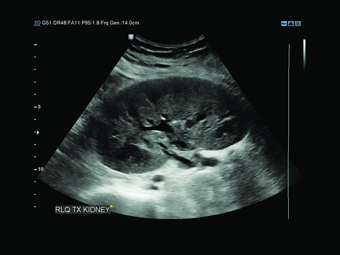 ultrasonography image of kidney by Samsung RS-80A